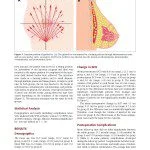 Autologous Fat Grafting for Breast Augmentation in Underweight Women