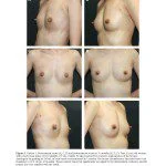 Autologous Fat Grafting for Breast Augmentation in Underweight Women