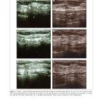 Autologous Fat Grafting for Breast Augmentation in Underweight Women