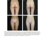 Autologous Fat Grafting for Breast Augmentation in Underweight Women