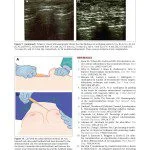 Autologous Fat Grafting for Breast Augmentation in Underweight Women