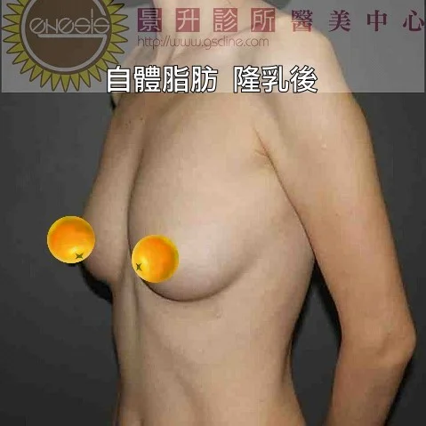 極瘦女性自體隆乳後