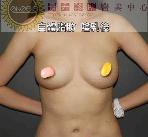 自體脂肪 隆乳後