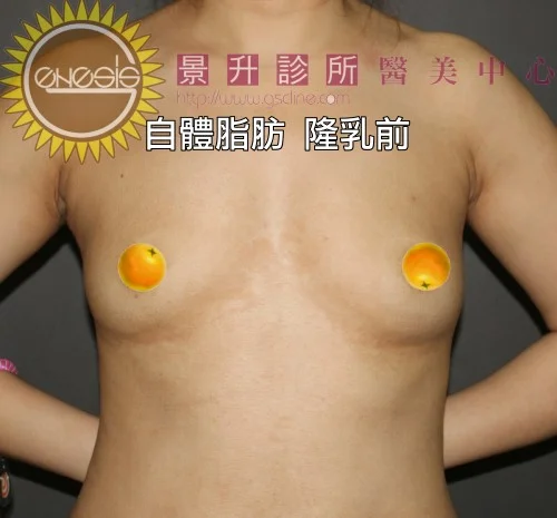 自體脂肪隆乳前