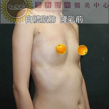 隆乳的最佳選擇-自體脂肪隆乳手術前