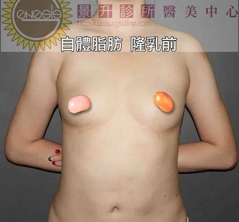 自體脂肪 隆乳前 左右不對稱