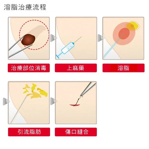 抽脂手術＿抽脂治療流程：抽脂是一種微創的局部脂肪消除方法＿景升診所