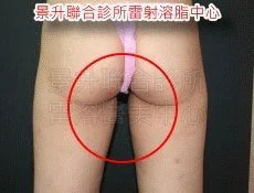 瘦大腿後